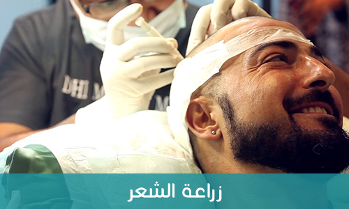 زراعة الشعر